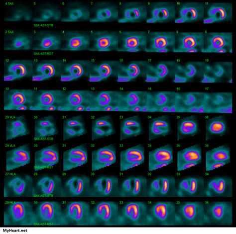 What to Expect: Nuclear Stress Test • MyHeart .net