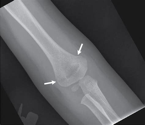 Grading supracondylar fracture - willstorm