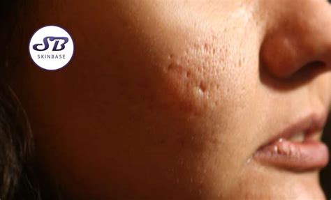 Can microdermabrasion help acne scars?