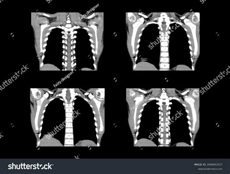 Chest Ct Scan Mri Images Stock Photo 2048053517 | Shutterstock