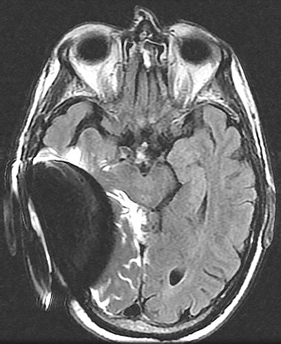 MR Imaging and Cochlear Implants with Retained Internal Magnets: Reducing Artifacts near Highly ...