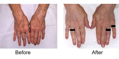 Premium Hand Vein Treatments | Madison Medispa, Waunakee