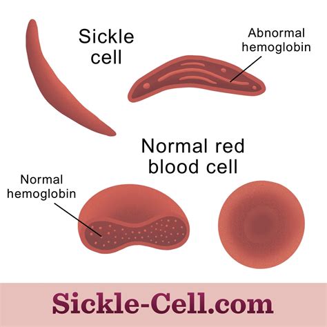 Hemoglobin Mutations Cause Sickle Cell Disease