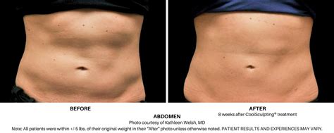 CoolSculpting for Stomach in Fulton, Maryland — Rejuvenate Wellness & MedSpa