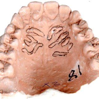 (PDF) Palatal Rugae: A Tool for Sex Identification in Forensic Odontology