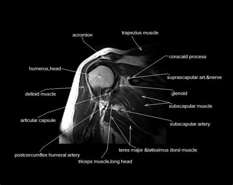 MRI shoulder anatomy | shoulder coronal anatomy | free cross sectional anatomy | | Shoulder ...