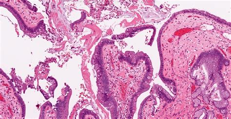 Pathology Outlines - Chronic cholecystitis