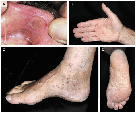 Primary and Secondary Syphilis | NEJM