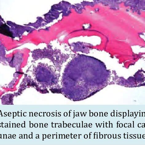 Aseptic necrosis of bone depicting a yellow, opaque perimeter with... | Download Scientific Diagram