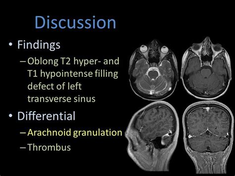 #arachnoid granulation.#transverse sign. | Anatomy bones, Mri brain ...