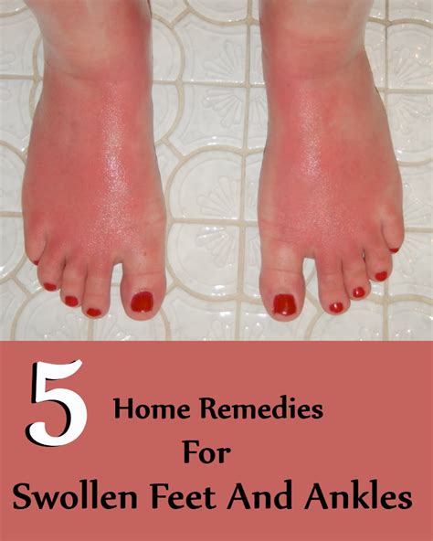 5 Home Remedies For Swollen Feet And Ankles | Search Home Remedy