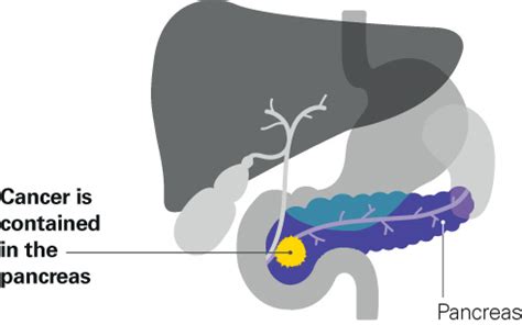 Stages Of Pancreatic Cancer