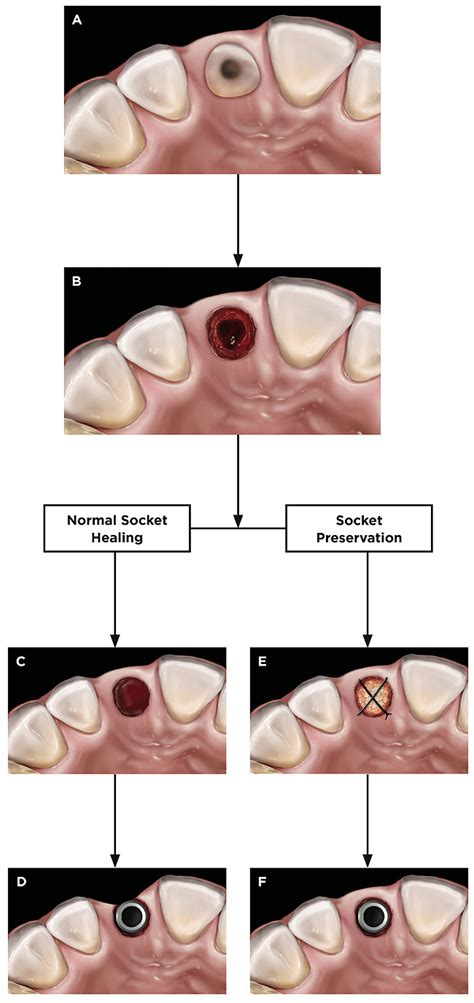 Normal Tooth Extraction Healing Pictures