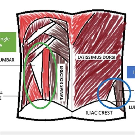 Diagrammatic representation of lumbar triangle anatomy. Image adapted ...