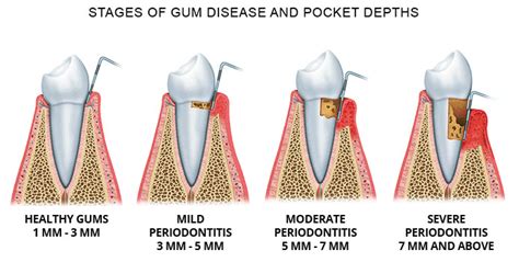 Periodontal Disease