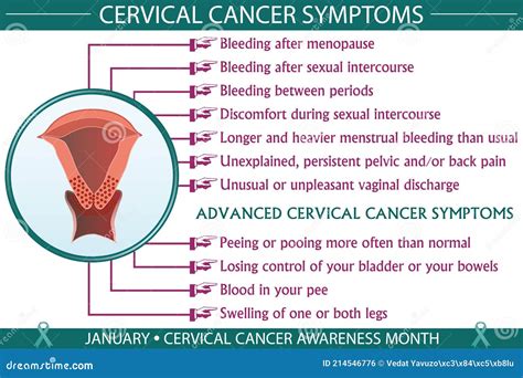 Cervical Cancer Symptoms Infographic Vector Illustration | CartoonDealer.com #214546776