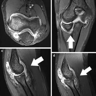 Confirmed PAPA syndrome during clinical flare at age 8 years in patient... | Download Scientific ...