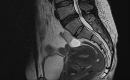 Uterus | Radiology Reference Article | Radiopaedia.org