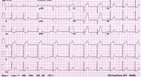 ECG Skills Trainer, Part I - ProProfs Quiz