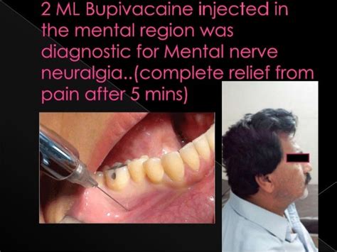 case ppt Mental nerve neuralgia