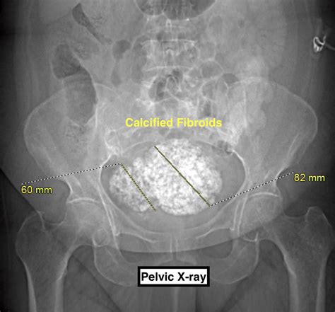 Effective Calcified Uterine Fibroid Treatment - Insights