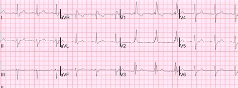 Dr. Smith's ECG Blog: Right Bundle Branch Block. What else?