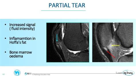 Patella Tendinosis and Tears What to look for on MRI - Radedasia