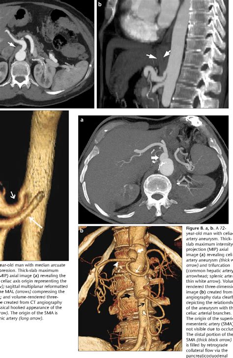 Figure 5 from CT angiography of the celiac trunk : anatomy , variants and pathologic findings ...