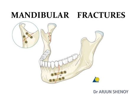 Orif Mandibular Fracture