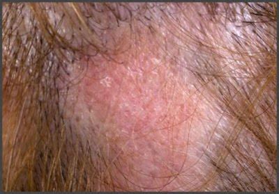 Pictures of shingles on the scalp | Shingles Expert