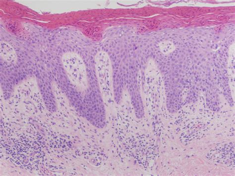 Necrolytic Migratory Erythema | Consultant360