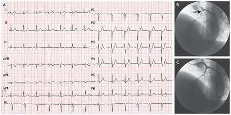 Left Main Coronary Artery Occlusion Ecg