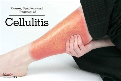 Cellulitis - Causes, Signs & Symptoms and Treatment - By Dr. Sandeep ...