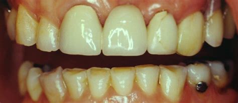 A Dental Bridge with Conventional Pontic | Cosmetic Dentistry