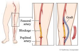 Understand Surgery: Femoral Popliteal Bypass