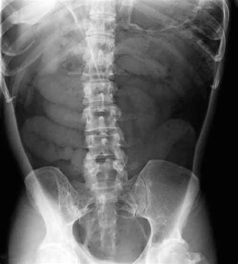 -Radiografía simple de abdomen. | Download Scientific Diagram