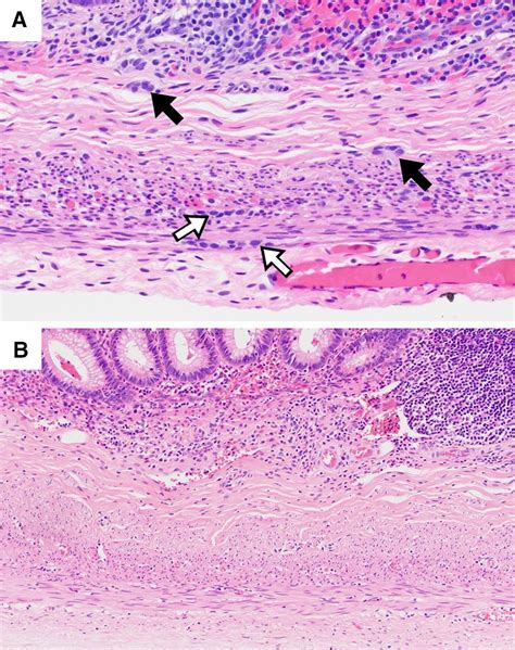 Appendix histology in infants: A Normal appendix of a neonate showing... | Download Scientific ...