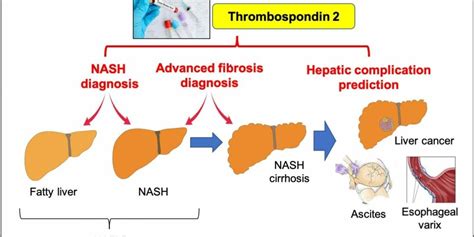 Blood Test Identifies Risk of Nonalcoholic Fatty Liver Disease | Clinical Lab Products