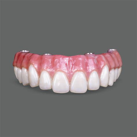 BruxZir® Solid Zirconia Full-Arch Implant Prosthesis - Smith-Sterling