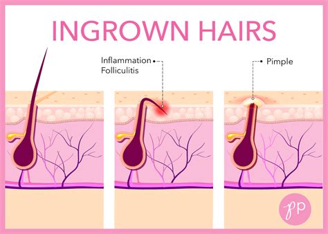 Ingrown Hairs- Charismatic Planet