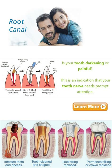 pain relief for root canal - dehass-lindbeck