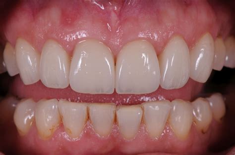 Services: Poor Porcelain Crowns | Brisbane Prosthodontics