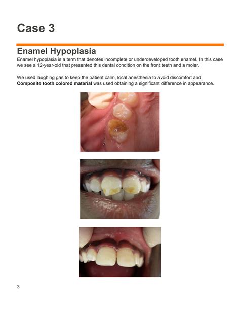 Enamel Hypoplasia | Miami, FL | Miami Children's Smiles