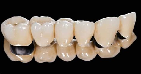 Puentes Dentales de Metal y Porcelana - Dental King El Salvador