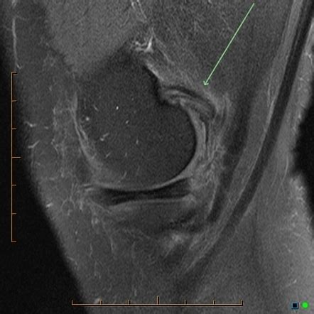 Proximal medial head gastrocnemius tendon tear and tendinopathy ...