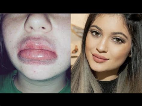 How To Get Kylie Jenner Lips With A Bottle Cap | Lipstutorial.org