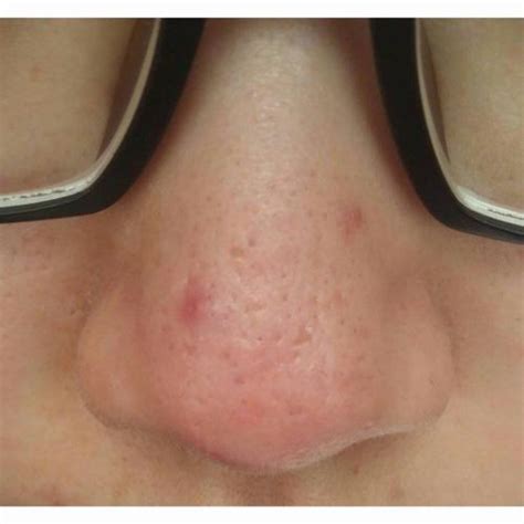 What Types Of Scars Are On My Nose? (With Pics) Help Plz! - Scar treatments - Acne.org