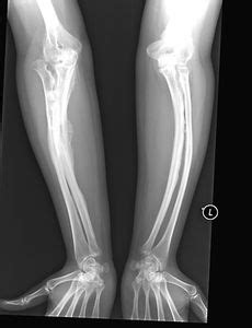 Osteogenesis imperfecta | disease | Britannica.com