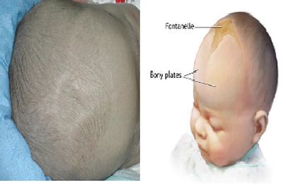 bulging anterior fontanelle in adults