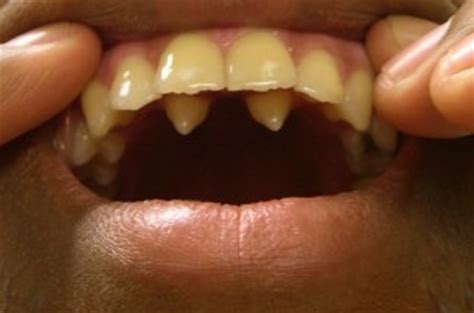 👉 Hyperdontia - Pictures, Causes, Treatment (February 2022)